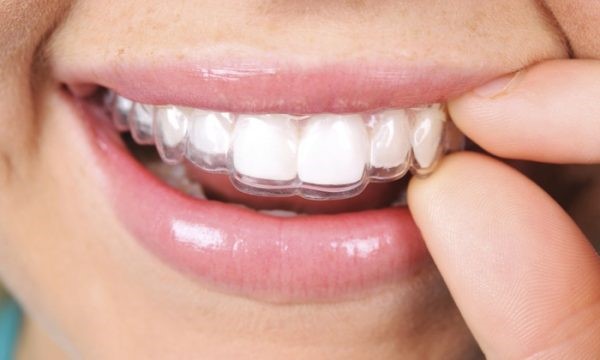 How Do I Stop Grinding My Teeth?