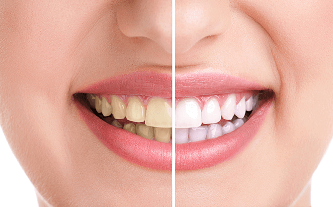 What is the Zoom Whitening Procedure?
